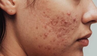 The Spiritual Meaning of Breakouts on Chin (Face Mapping):All You Need To Know