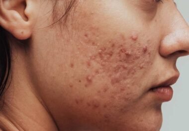 The Spiritual Meaning of Breakouts on Chin (Face Mapping):All You Need To Know