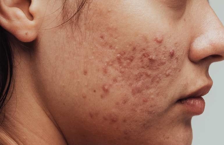The Spiritual Meaning of Breakouts on Chin (Face Mapping):All You Need To Know